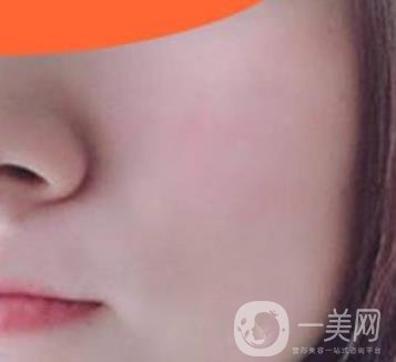 沈陽伊美爾整形醫(yī)院價格表，附祛斑*果展示