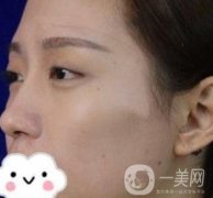臺州博雅美惠醫(yī)療美容整形雙眼皮恢復日記，內(nèi)附價格表明細