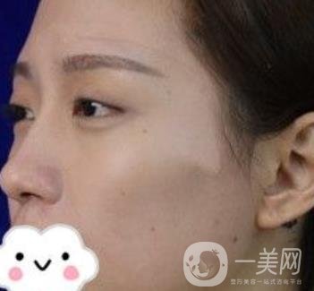 臺(tái)州博雅美惠醫(yī)療美容整形雙眼皮恢復(fù)日記，內(nèi)附價(jià)格表明細(xì)