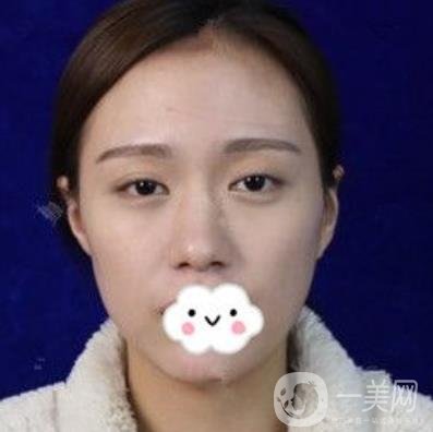 臺(tái)州博雅美惠醫(yī)療美容整形雙眼皮恢復(fù)日記，內(nèi)附價(jià)格表明細(xì)