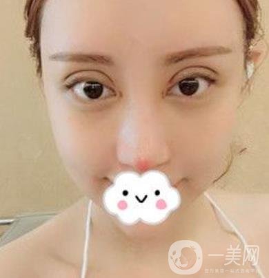 臺(tái)州博雅美惠醫(yī)療美容整形雙眼皮恢復(fù)日記，內(nèi)附價(jià)格表明細(xì)
