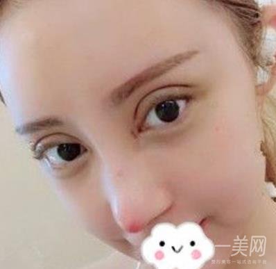 臺(tái)州博雅美惠醫(yī)療美容整形雙眼皮恢復(fù)日記，內(nèi)附價(jià)格表明細(xì)