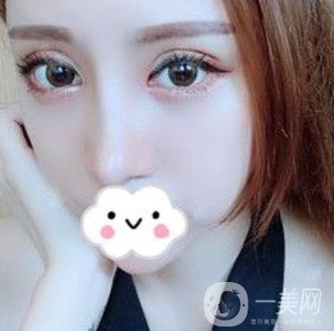 臺(tái)州博雅美惠醫(yī)療美容整形雙眼皮恢復(fù)日記，內(nèi)附價(jià)格表明細(xì)