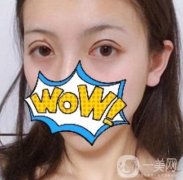 武漢艾萊美醫(yī)療整形醫(yī)院價格表項目收費明細，附雙眼皮案例