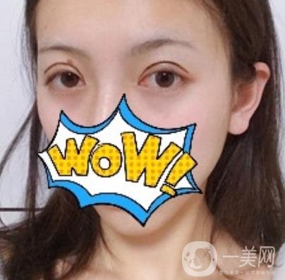 武漢艾萊美醫(yī)療整形醫(yī)院價(jià)格表項(xiàng)目收費(fèi)明細(xì)，附雙眼皮案例