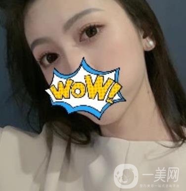 武漢艾萊美醫(yī)療整形醫(yī)院價(jià)格表項(xiàng)目收費(fèi)明細(xì)，附雙眼皮案例
