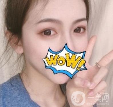 武漢艾萊美醫(yī)療整形醫(yī)院價(jià)格表項(xiàng)目收費(fèi)明細(xì)，附雙眼皮案例