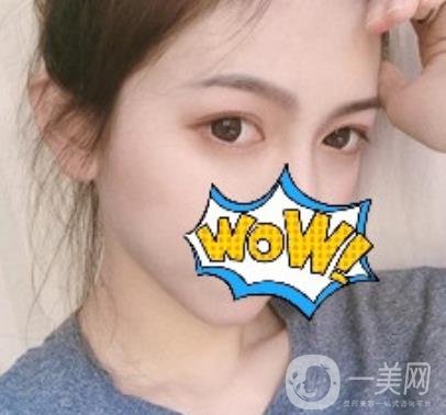 武漢艾萊美醫(yī)療整形醫(yī)院價(jià)格表項(xiàng)目收費(fèi)明細(xì)，附雙眼皮案例