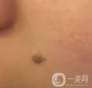 重醫(yī)附一院祛痣怎么樣？多少錢一顆？附整形價格表及案例果