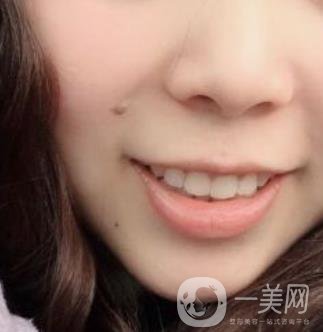 重醫(yī)附一院祛痣怎么樣?多少錢一顆?附整形價格表及案例*果