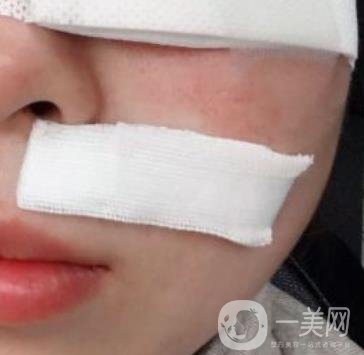 重醫(yī)附一院祛痣怎么樣?多少錢一顆?附整形價格表及案例*果