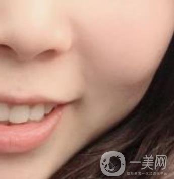 重醫(yī)附一院祛痣怎么樣?多少錢一顆?附整形價格表及案例*果