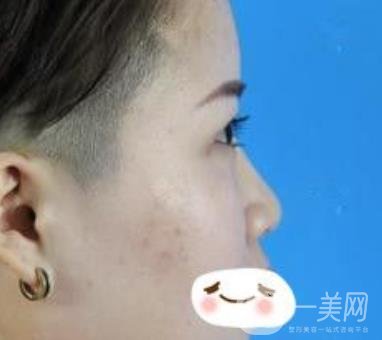 四川省人民醫(yī)院整形科駝峰鼻矯正多少錢？價格表2020更新