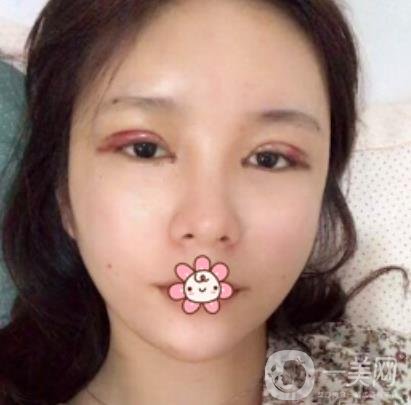 襄陽中心醫(yī)院整形美容科價(jià)格表2020版出爐，附雙眼皮日記