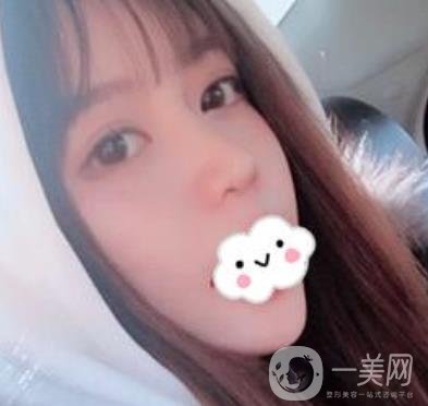 合肥中山醫(yī)院整形科價(jià)格表2020，附雙眼皮恢復(fù)*果
