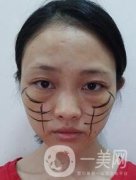 徐州亞韓整形醫(yī)院價格表費用明細，附面部除皺日記展示