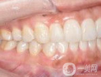 武漢大學(xué)口腔醫(yī)院牙齒矯正多少錢?*果好嗎?價格費(fèi)用明細(xì)一覽