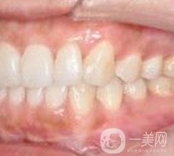 武漢大學(xué)口腔醫(yī)院牙齒矯正多少錢?*果好嗎?價格費(fèi)用明細(xì)一覽
