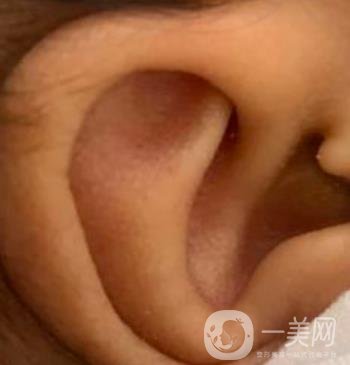中國醫(yī)學(xué)科學(xué)院整形外科醫(yī)院外耳再造技術(shù)如何?*果好嗎?價格表收費標(biāo)準(zhǔn)一覽