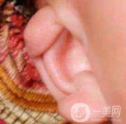 中國醫(yī)學(xué)科學(xué)院整形外科醫(yī)院外耳再造技術(shù)如何?果好嗎?價格表收費標準一覽