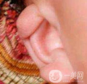 中國醫(yī)學(xué)科學(xué)院整形外科醫(yī)院外耳再造技術(shù)如何?*果好嗎?價格表收費標(biāo)準(zhǔn)一覽