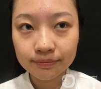 北京知音醫(yī)療美容熱瑪吉果怎么樣？貴嗎？收費價格表2020公布