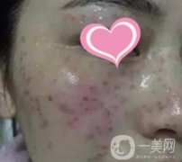 徐州二院激光祛斑怎么樣？案例及2020整形價格表一覽