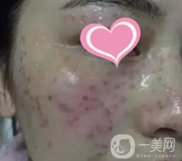 徐州二院激光祛斑怎么樣?案例及2020整形價格表一覽