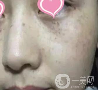 徐州二院激光祛斑怎么樣?案例及2020整形價格表一覽