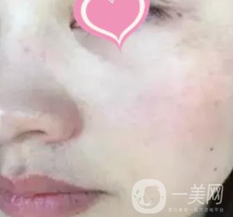 徐州二院激光祛斑怎么樣?案例及2020整形價格表一覽