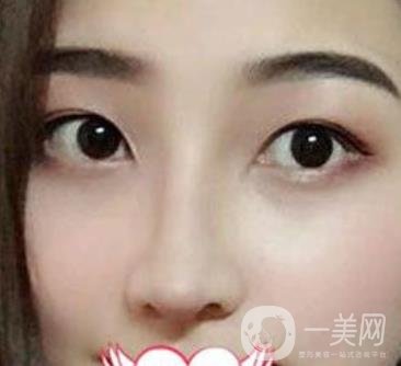 交大一附院王瑞做鼻子怎么樣？價格表及術(shù)后*果分享