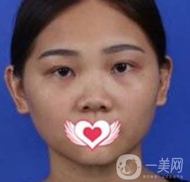 交大一附院王瑞做鼻子怎么樣？價格表及術(shù)后*果分享