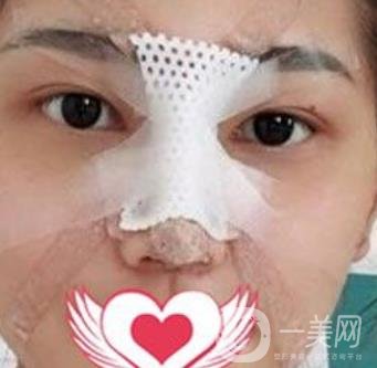 交大一附院王瑞做鼻子怎么樣？價格表及術(shù)后*果分享