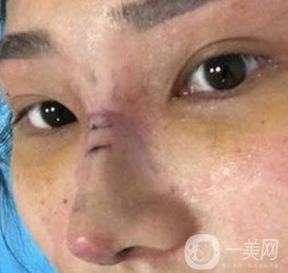 交大一附院王瑞做鼻子怎么樣？價格表及術(shù)后*果分享