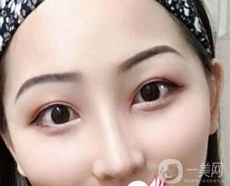 交大一附院王瑞做鼻子怎么樣？價格表及術(shù)后*果分享