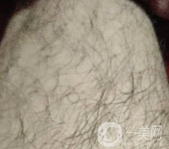 合肥華美整形醫(yī)院價格表，附脫毛案例