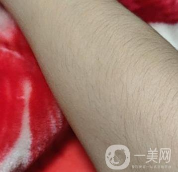 合肥華美整形醫(yī)院價格表，附脫毛案例