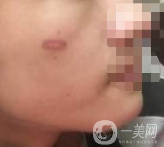 徐州第一人民醫(yī)院整形科價格表，含激光祛疤*果