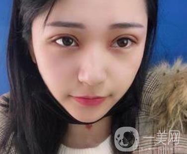 恩施州中心醫(yī)院美容整形科怎么樣？?jī)r(jià)格表和雙眼皮整形經(jīng)歷分享