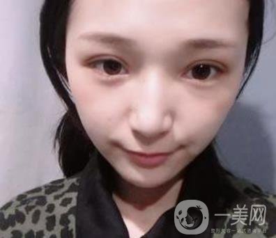 恩施州中心醫(yī)院美容整形科怎么樣？?jī)r(jià)格表和雙眼皮整形經(jīng)歷分享