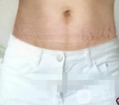 汾陽醫(yī)院美容整形科祛妊娠紋怎么樣？手術(shù)項目收費價格表和案例一覽