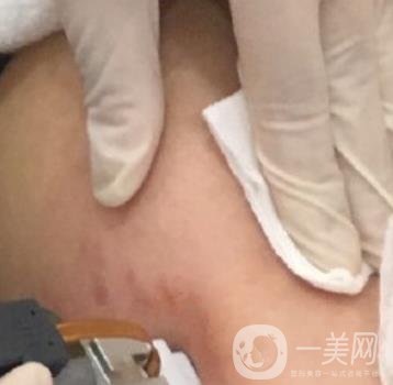 汾陽醫(yī)院美容整形科祛妊娠紋怎么樣？手術(shù)項目收費價格表和案例一覽