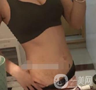 汾陽醫(yī)院美容整形科祛妊娠紋怎么樣？手術(shù)項目收費價格表和案例一覽