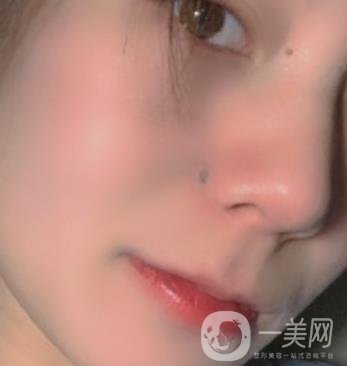黃岡市中心醫(yī)院美容整形科祛痣多少錢？價格費用表和*果圖精選