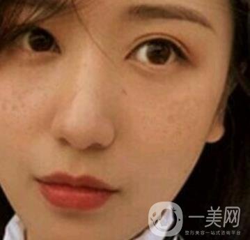 荊州市第三人民醫(yī)院整形美容科*祛斑*果好嗎？收費(fèi)價(jià)格明細(xì)表一覽