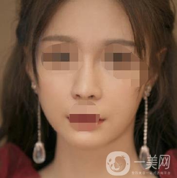 河北省人民醫(yī)院激光祛斑多少錢?附2020整形價格表一覽