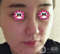 鼓樓醫(yī)院可以打*嗎？附案例恢復(fù)圖及整形價格表
