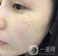 蘇州附一醫(yī)院可以激光祛斑嗎？案例圖及整形價格表分享