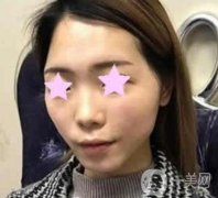 北大醫(yī)院整形美容科價(jià)格表，自體脂肪填充面部果怎么樣
