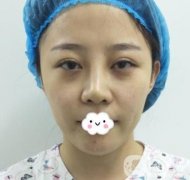 玫瑰醫(yī)院整形美容價(jià)格表，自體脂肪填充面部前后圖